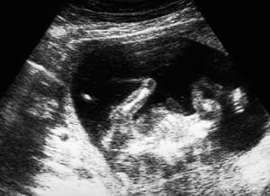 babies-defects