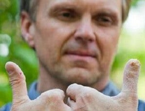 Miracle Powder Regrows Fingers, Now Thigh Muscle for Marine