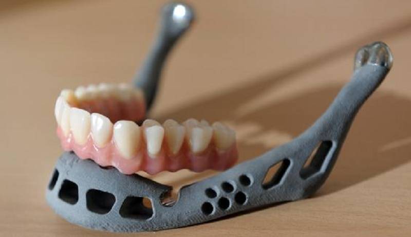 Another First For 3D Printing – Woman Receives Jaw Implant