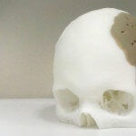 OsteoFab implant