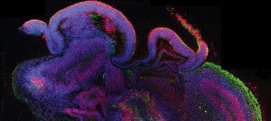 How Tiny Lab-Grown Human Brains Are Giving Big Insights Into Autism