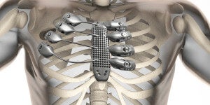 We Can Rebuild Him: Patient Receives 3D Printed Titanium Ribs and Sternum