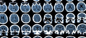Gene Therapy May Be Our Newest -- and Most Effective -- Weapon Against Alzheimer's Disease