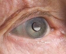 implantable-telescope-FDA-approval