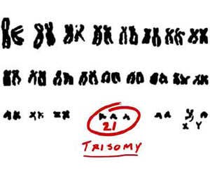 Trisomy21