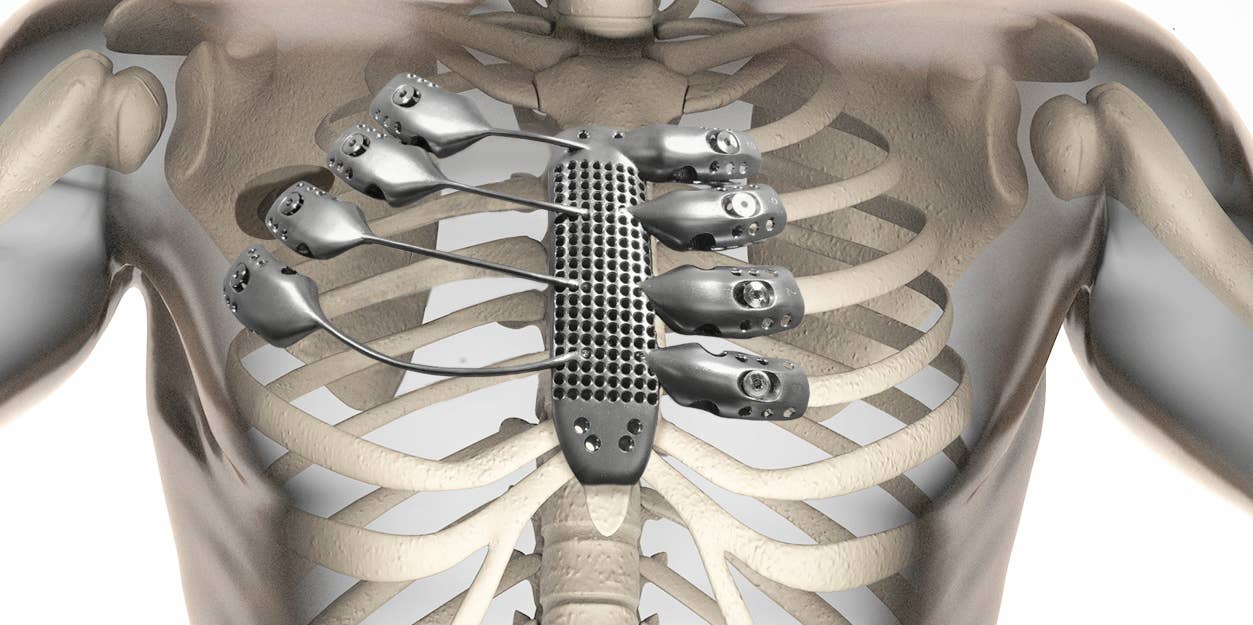 we-can-rebuild-him-patient-receives-3d-printed-titanium-ribs-and-sternum