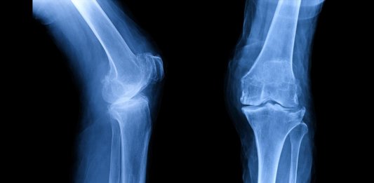 xray film showing osteoarthritis knee