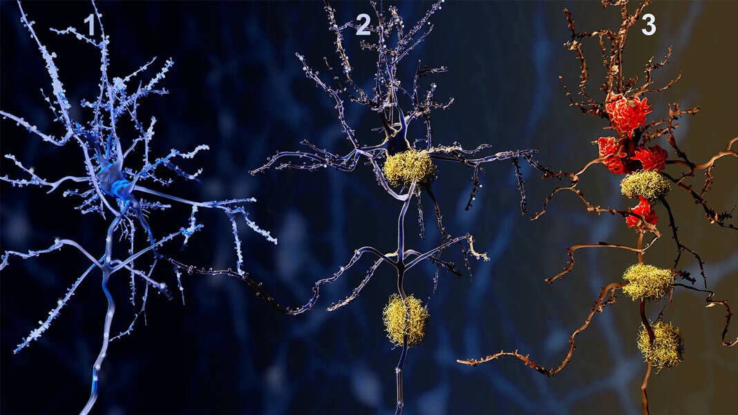 3 phases neurons alzheimer disease gene therapy