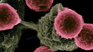 Autoimmune Diseases Stopped in Their Tracks by ‘Phenomenal’ Donor Cell Therapy