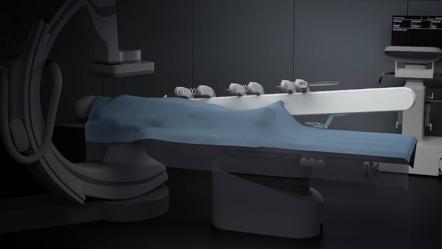 In Wild Experiment, Surgeon Uses Robot to Remove Blood Clot in Brain 4,000 Miles Away A surgeon used a surgical robot to complete a stroke surgery on a brain 4,000 miles away.