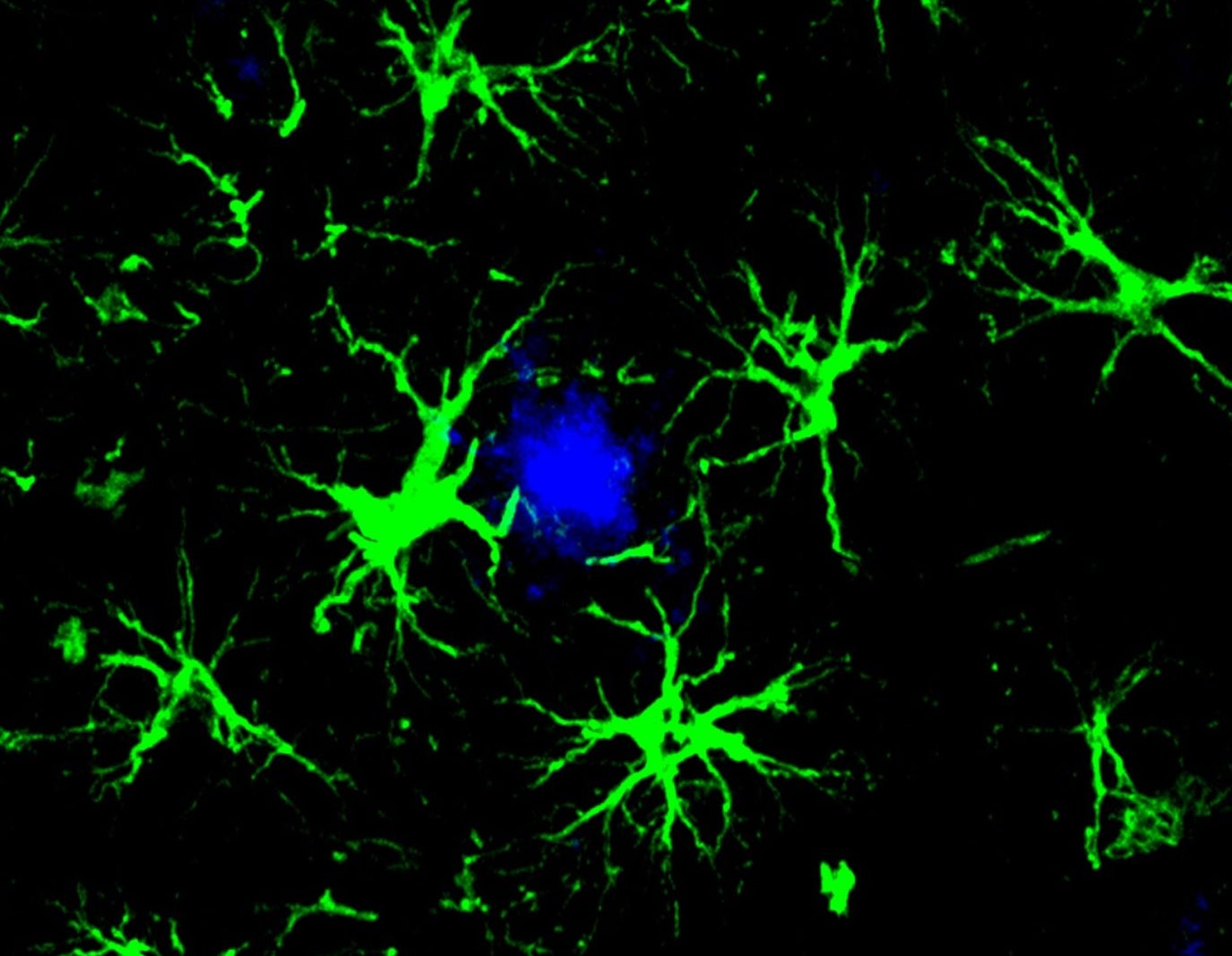 Brain cells called astrocytes surround amyloid beta plaque