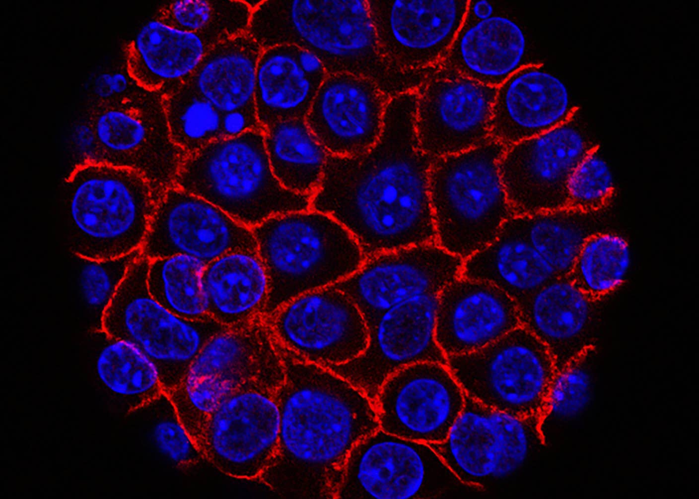 These Supercharged Immune Cells Completely Eliminated Solid Tumors in Mice Pancreatic cancer cells