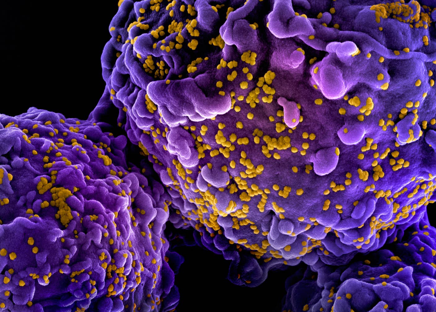 Norwegian Man Cured of HIV by His Brother’s Stem Cells Colorized scanning electron micrograph of HIV-1 virus particles (yellow) both budding and attached to the surface of Hut-78/human lymphocyte cells (purple). Image captured at the NIAID Integrated Research Facility in Fort Detrick, Maryland.