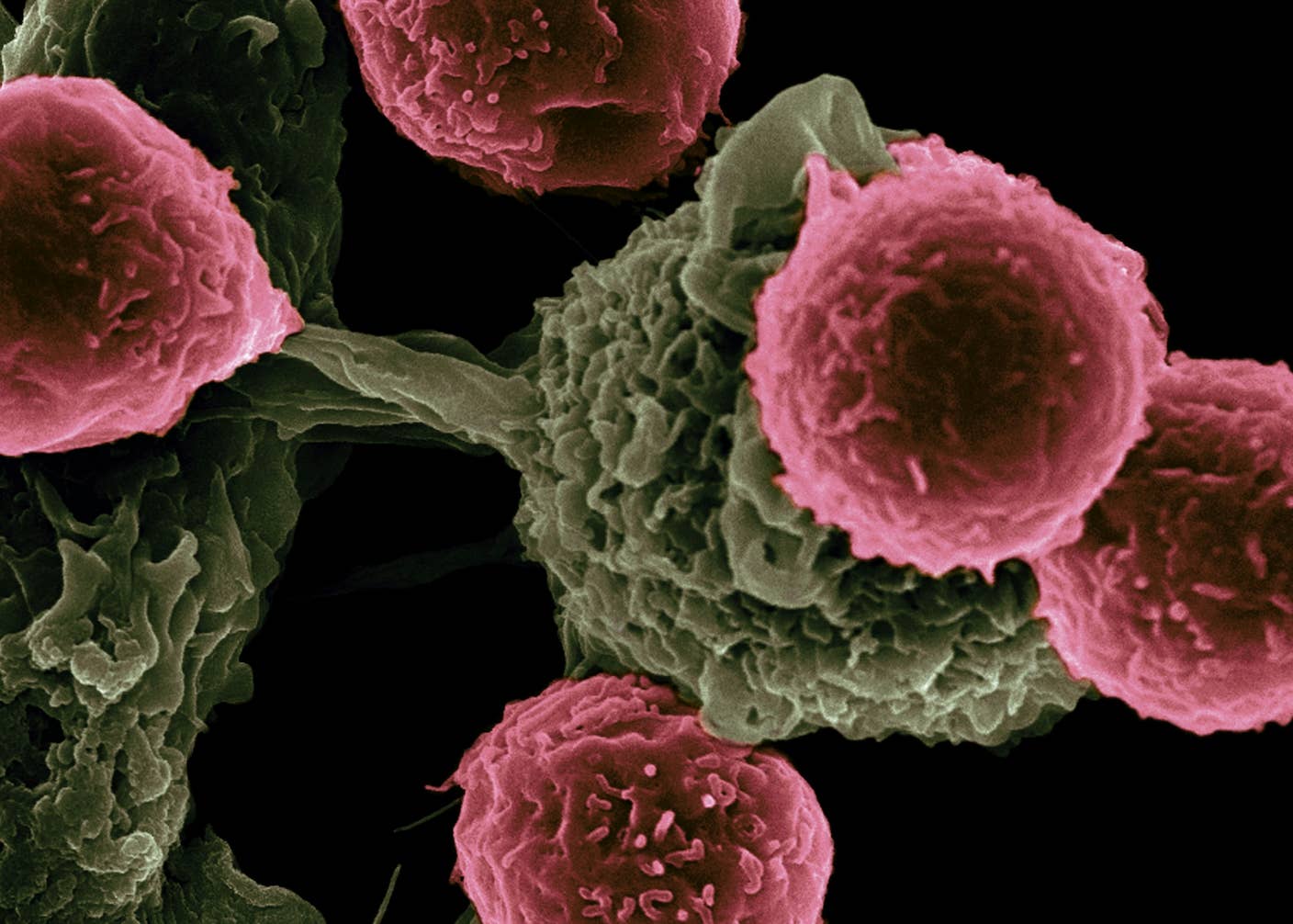 A Revolutionary Cancer Treatment Could Transform Autoimmune Disease A Revolutionary Cancer Treatment Could Transform Autoimmune Disease