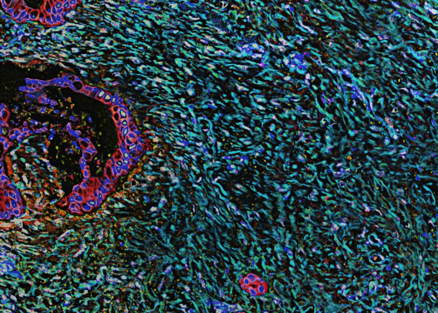 Dense, scar-like tissue forms around pancreatic cancer tumor