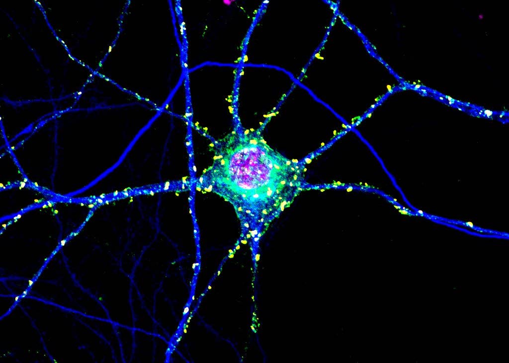 Toxic Clumps in Huntington’s Disease May Protect the Brain Too Signaling neurons