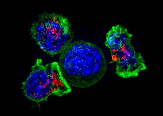 CAR T Revolutionized How We Treat Blood Cancers. Now It’s Closing In on Solid Tumors. Killer T cells surround a cancer cell