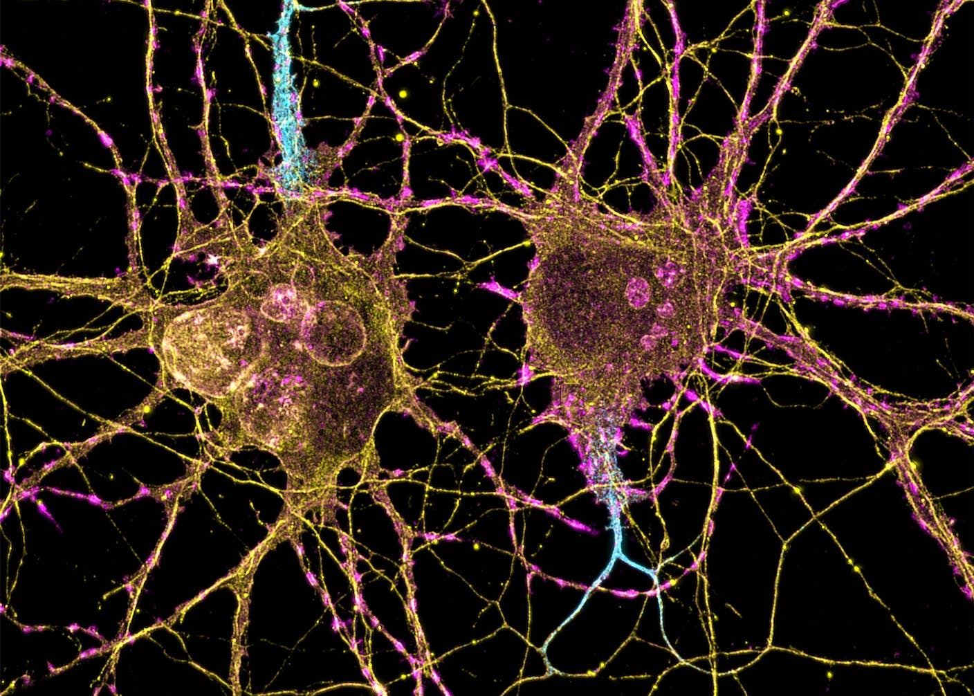 This Drug Makes New Neurons in the Brain. Scientists Say It Reversed Alzheimer’s Symptoms in Mice. Neurons with branching connections under the microscope.