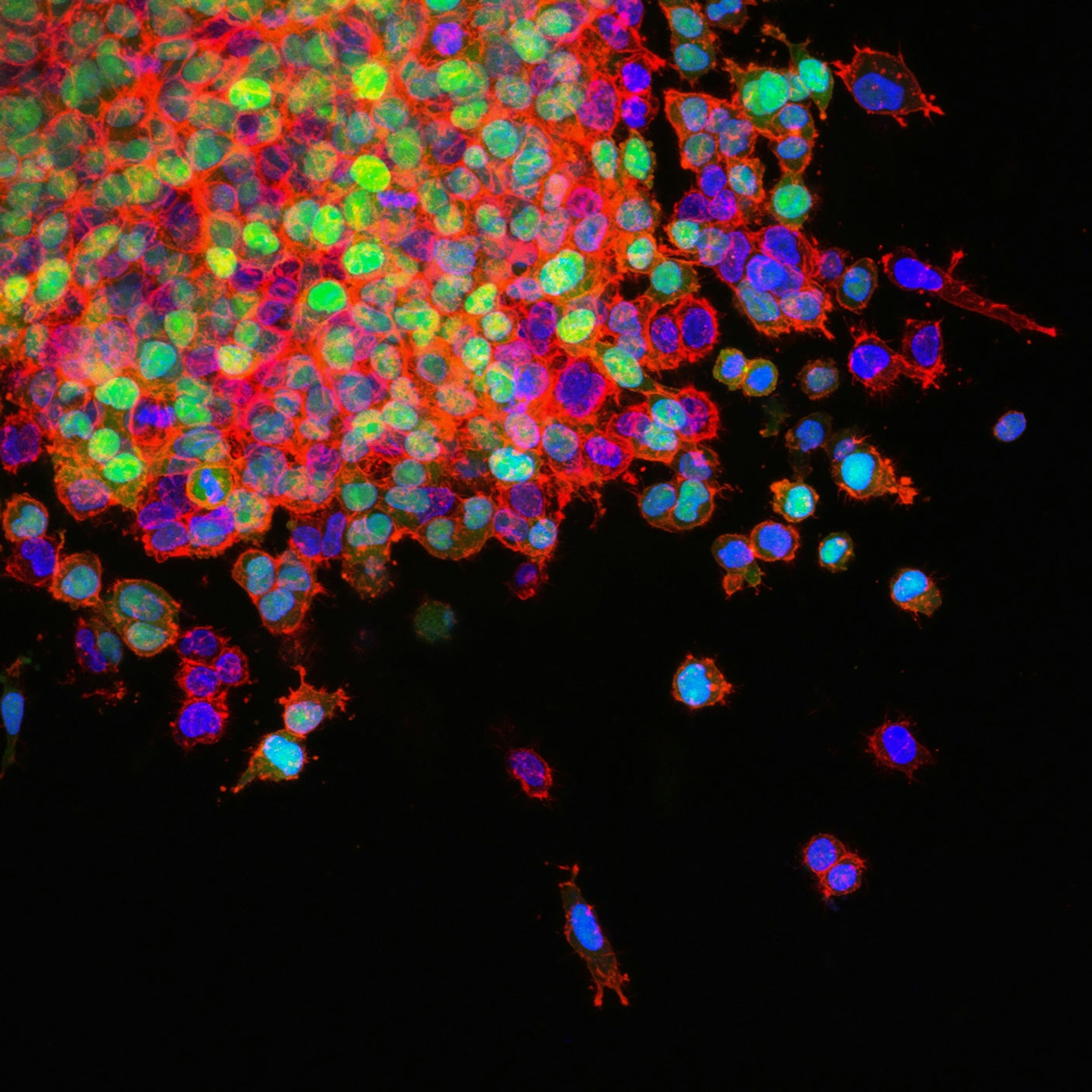 Metastasizing lung cancer cells under the microscope.
