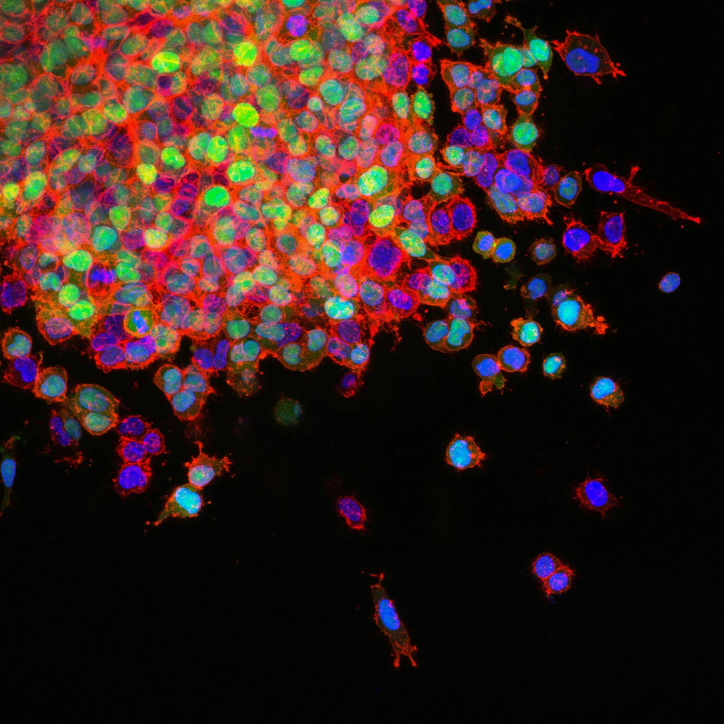 Three-Year-Old Boy’s Metastatic Cancer Disappears After Two Shots of Experimental Cell Therapy Metastasizing lung cancer cells under the microscope.
