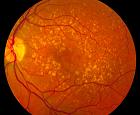 embryonic-stem-cell-retina