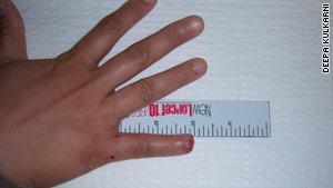 regrown-fingertip-injury