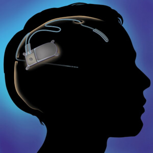 NeuroPace_Epileptic_Brain_Implant - Singularity Hub