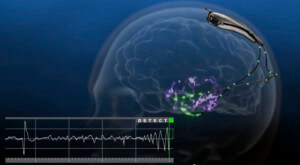 FDA Approves Brain Implant to Monitor and Autonomously Respond to ...