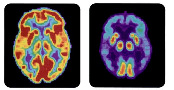 PET_scan-normal_brain-alzheimers_disease_brain-banner