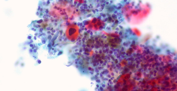 squamous cell carcinoma, cancer, nanomedicine, nanotechnology, nanobubbles, lapotko, chemotherapy, cancer treatments