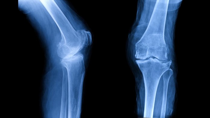 xray film showing osteoarthritis knee