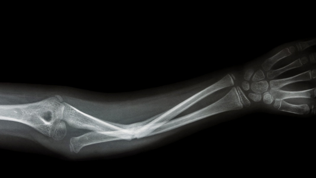 forearm ap fracture xray film graphite nanotechnology