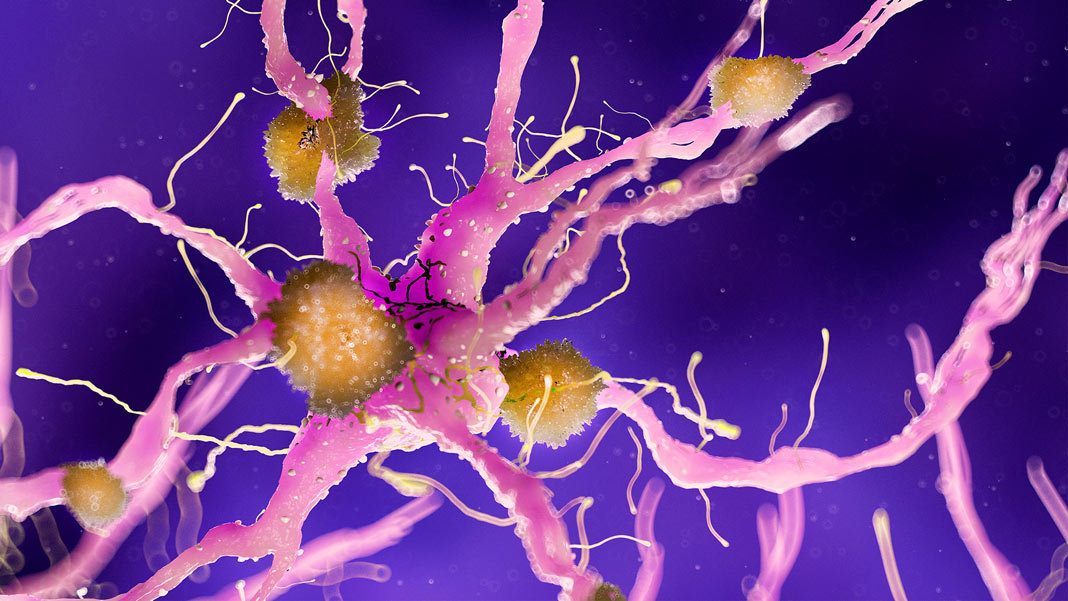 medically accurate amyloid 3D illustration neuroscience