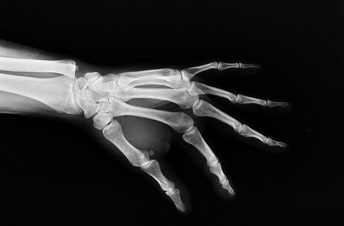 3d printed bones particle3d 3d printing implants