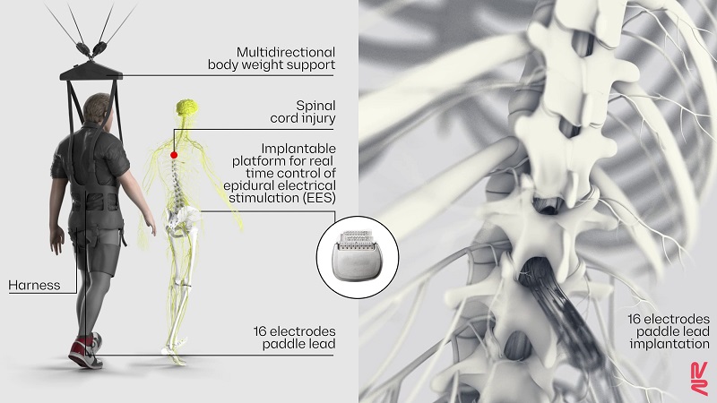 Electrical Zaps Woke Up Dormant Neurons to Help Paralyzed People Walk Again