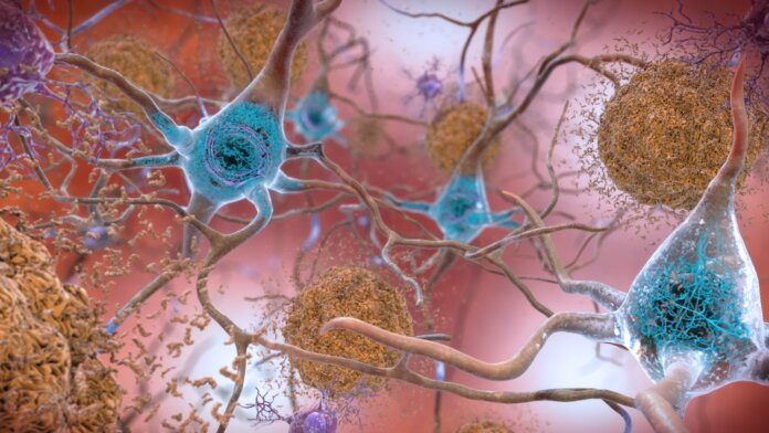 Alzheimer's neurons in brain beta amyloid protein clumps